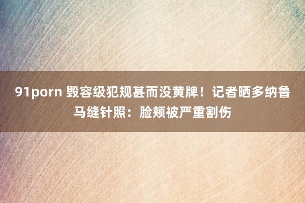 91porn 毁容级犯规甚而没黄牌！记者晒多纳鲁马缝针照：脸颊被严重割伤